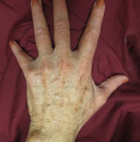 лечение коричневых точек на коже