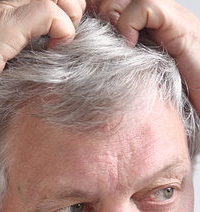 Псориаз волосистой части головы: не приговор, но руководство к действию 