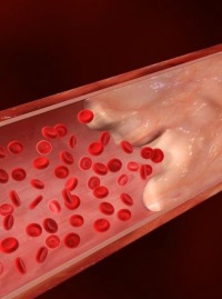 Тромбоэмболия легочной артерии – смертельный сгусток крови 