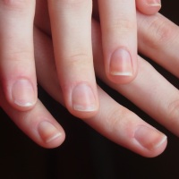 как лечить ногти после наращивания