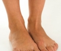 Отеки ног: лечение зависит от причины