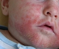 Стрептодермия у детей: инфекционное заболевание кожи