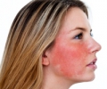 Лечение купероза на лице – обратитесь к дерматологу