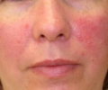 Купероз на лице – признак заболевания внутренних органов