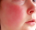 Как лечить купероз на лице и можно ли от него избавиться?