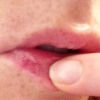 лечение герпеса на губах