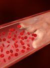 тромбоэмболия легочной артерии